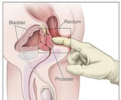 How to Find the Prostate